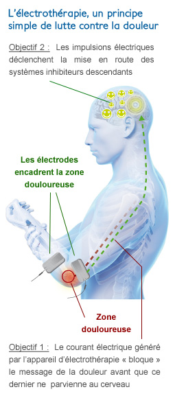 comment l'électrothérapie bloque la douleur due à l'arthrose